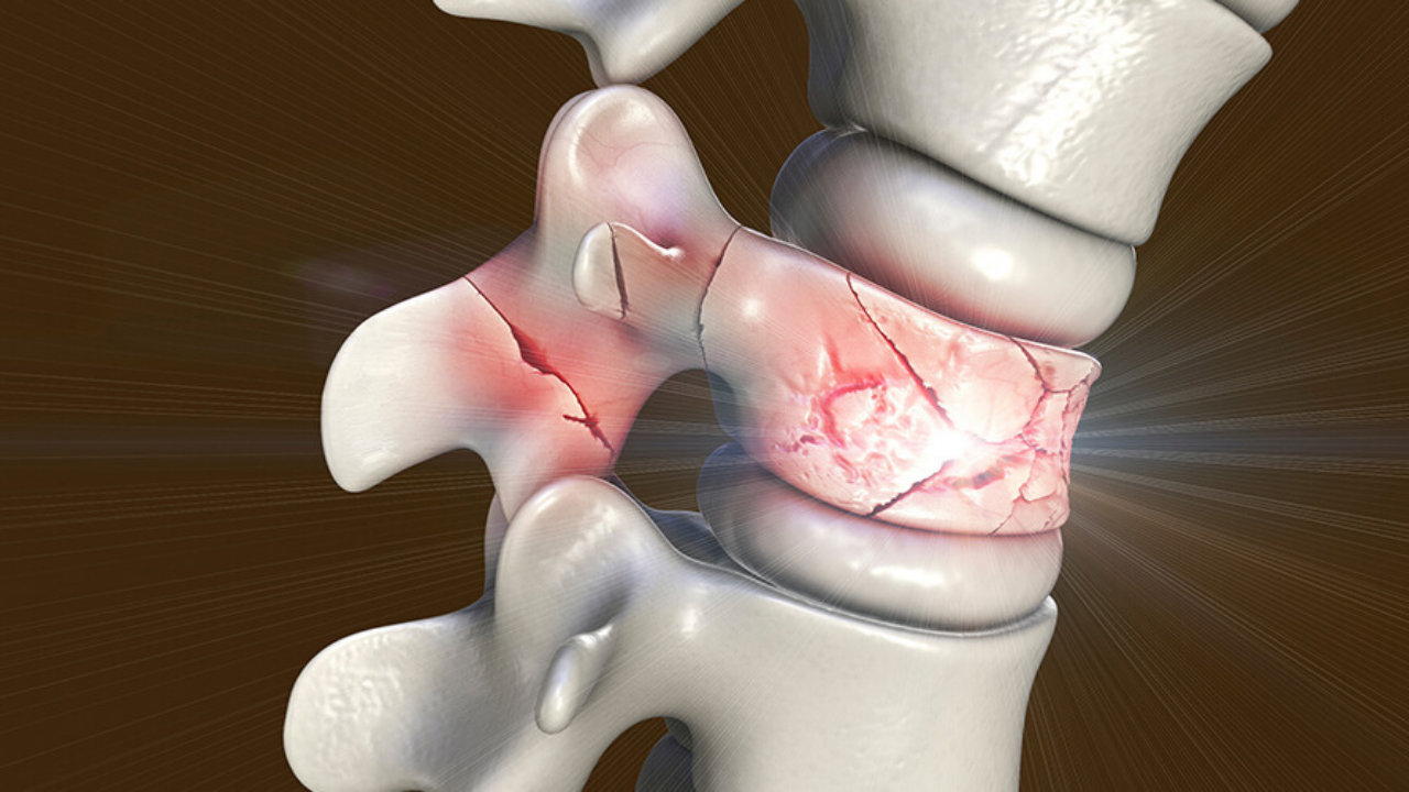 Stem Cell Therapy for Bone Fractures