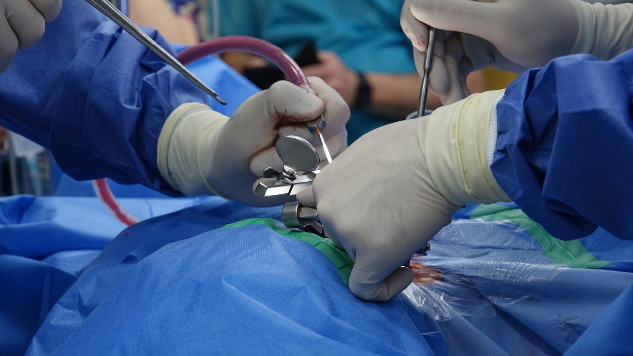 Stem Cell Therapy for Spinal Osteoarthritis