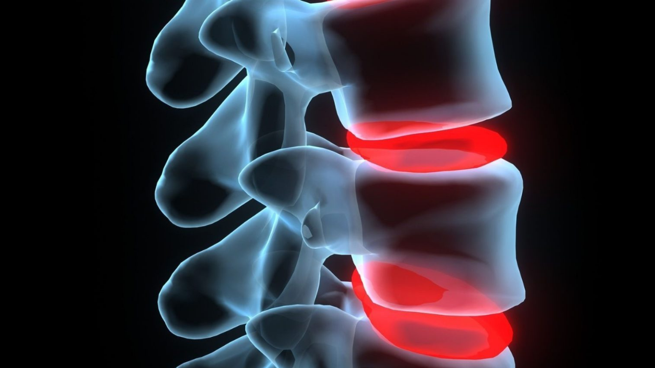 Stem Cell Therapy for Facet Syndrome